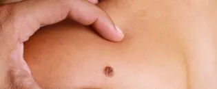 Early Detection of Skin Cancer Through Noncontact Infrared Thermography