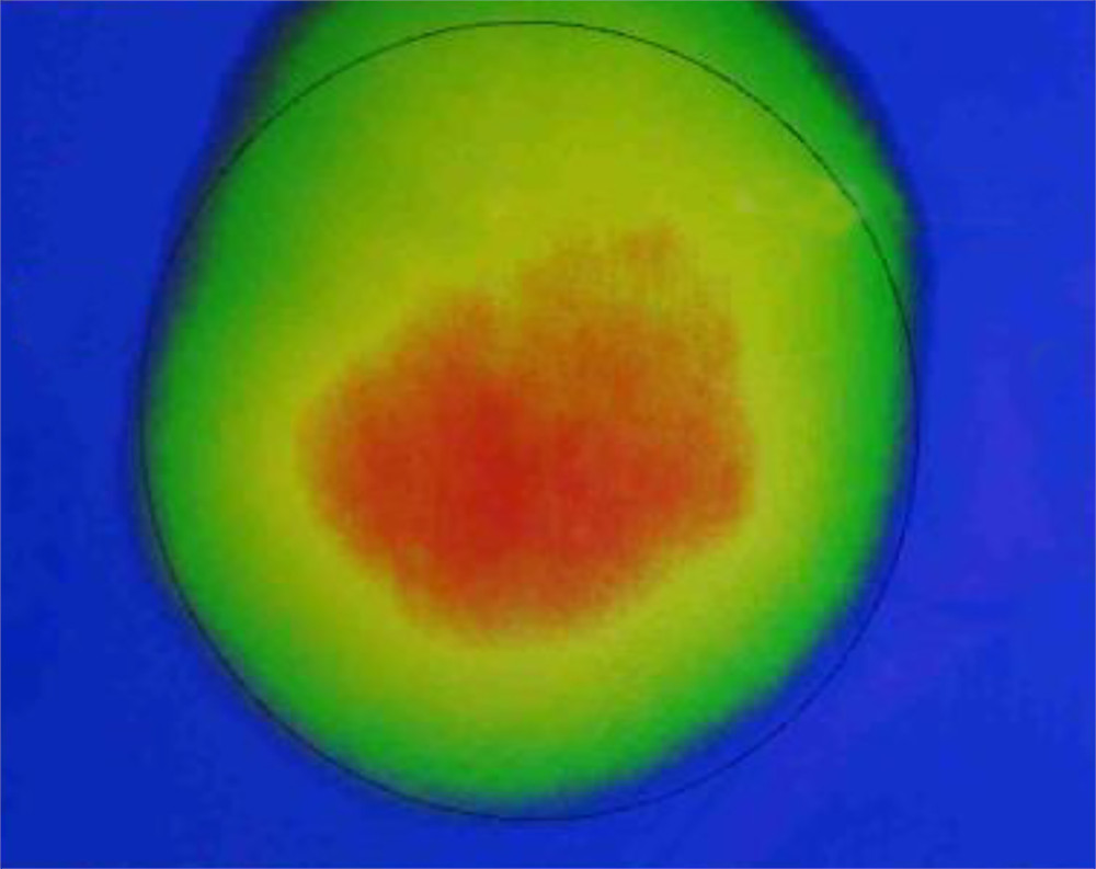 Infrared Thermography in Skin Cancer Research